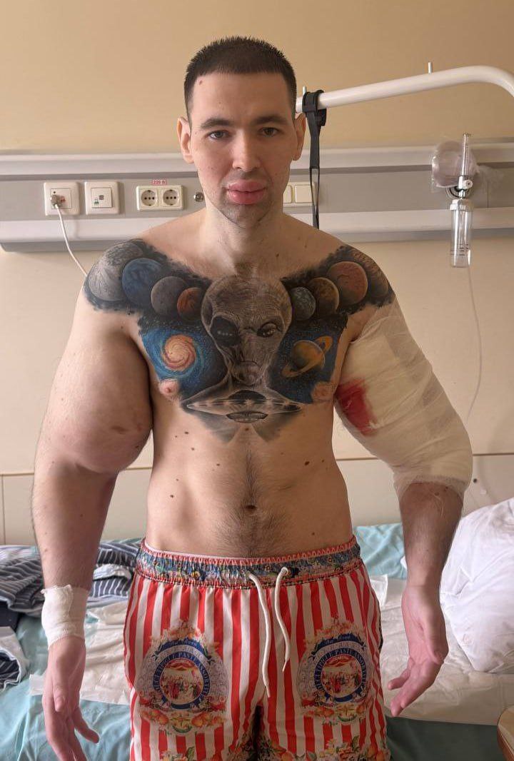 «Рукам-Базукам» грозит ампутация — его руки гниют, а операции, которые могли бы его спасти, делать нельзя «Рукам-Базукам» грозит ампутация — его руки гниют, а операции, которые могли бы его спасти, делать нельзя