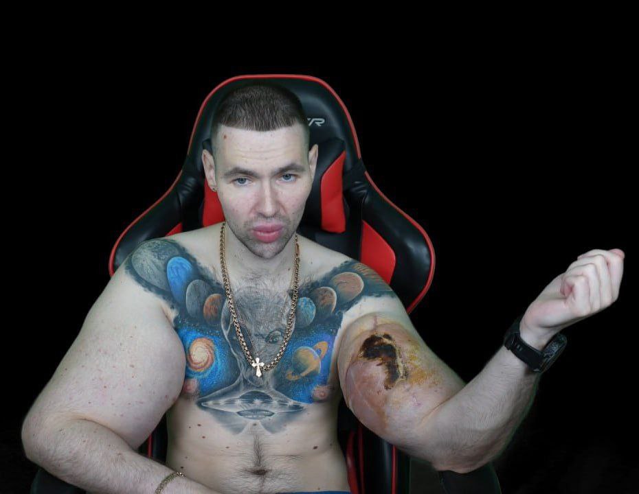 «Рукам-Базукам» грозит ампутация — его руки гниют, а операции, которые могли бы его спасти, делать нельзя