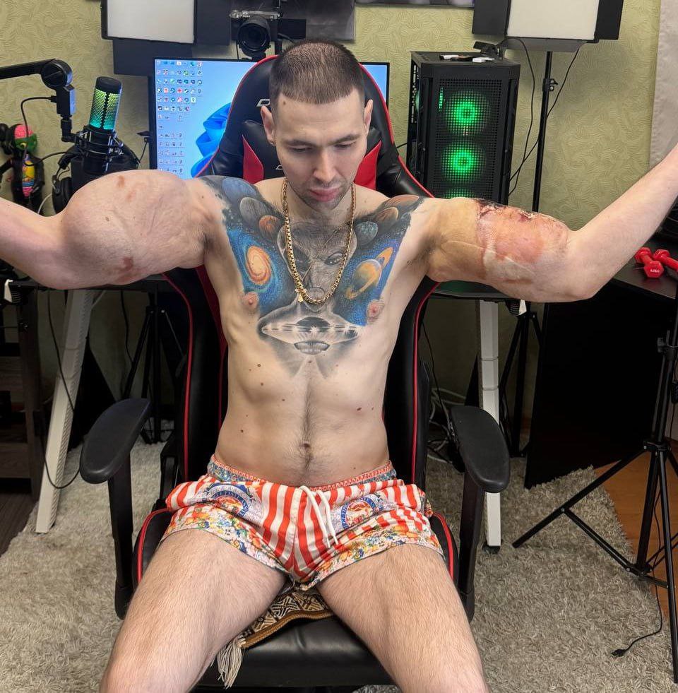 «Рукам-Базукам» грозит ампутация — его руки гниют, а операции, которые могли бы его спасти, делать нельзя «Рукам-Базукам» грозит ампутация — его руки гниют, а операции, которые могли бы его спасти, делать нельзя