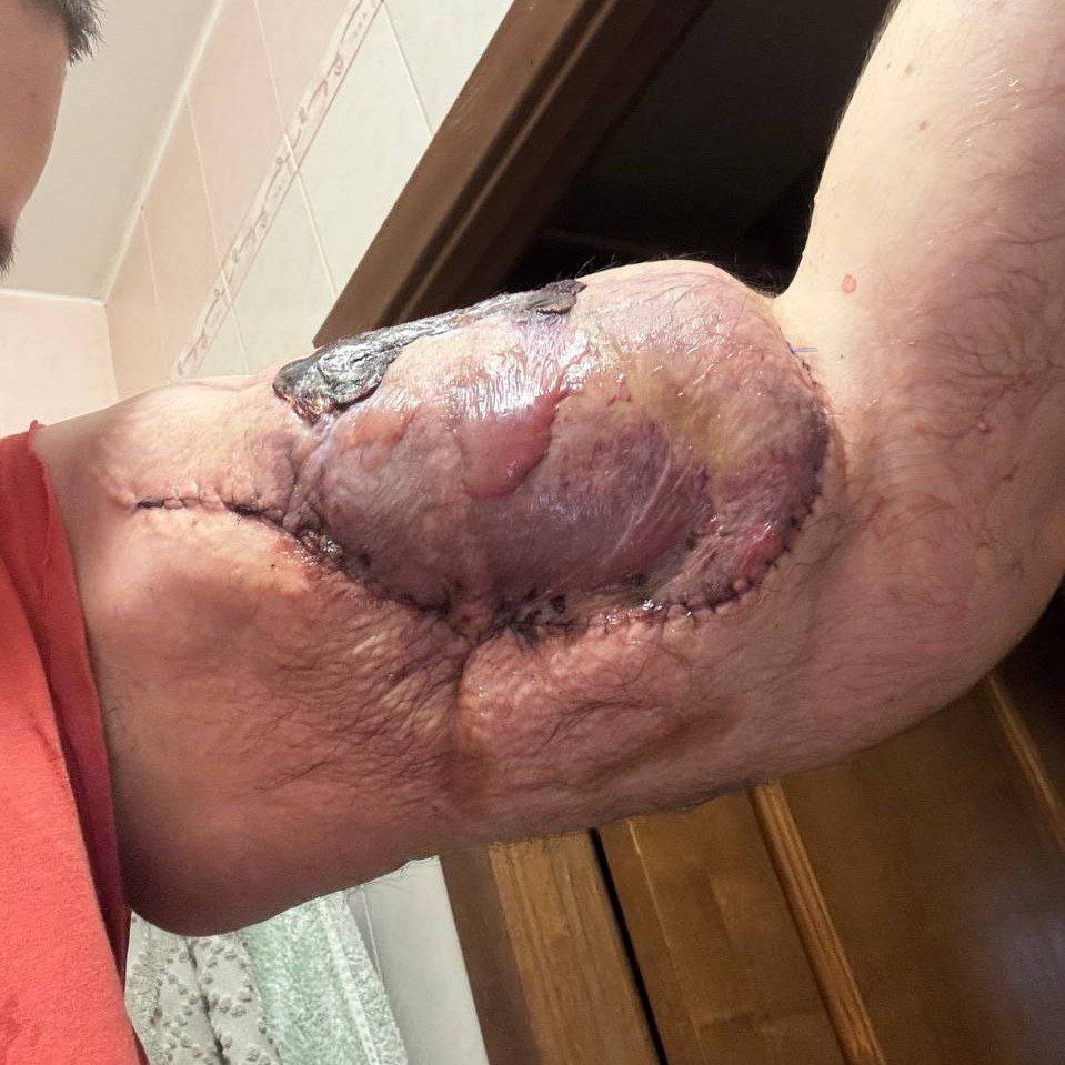 «Рукам-Базукам» грозит ампутация — его руки гниют, а операции, которые могли бы его спасти, делать нельзя «Рукам-Базукам» грозит ампутация — его руки гниют, а операции, которые могли бы его спасти, делать нельзя