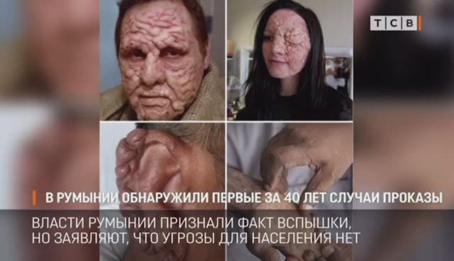 Случаи проказы обнаружили в Румынии впервые за 40 лет