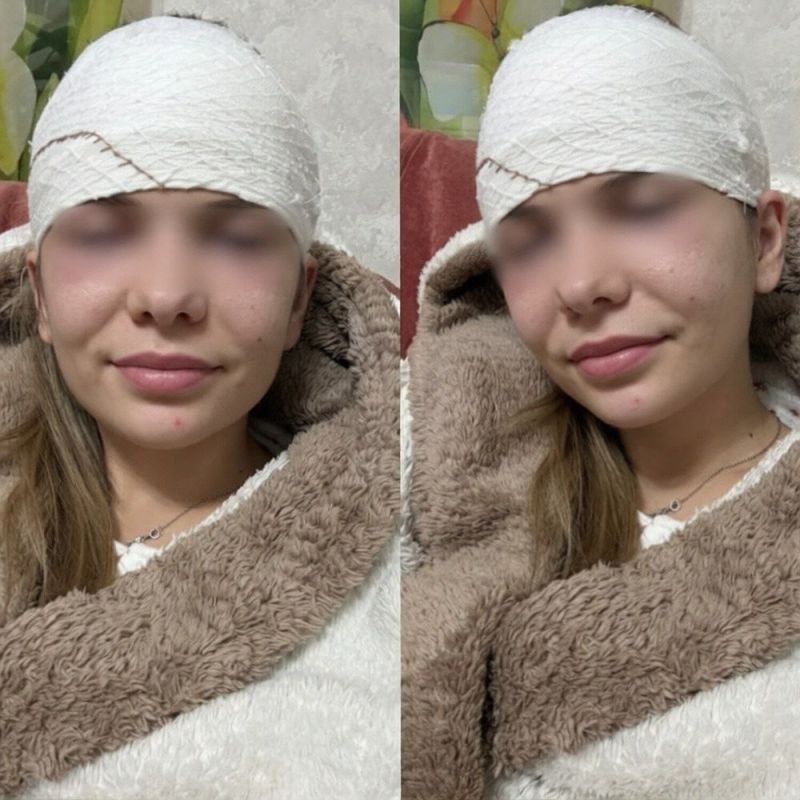 Из-за обычного прыщика россиянке разрезали лоб и положили в больницу Из-за обычного прыщика россиянке разрезали лоб и положили в больницу